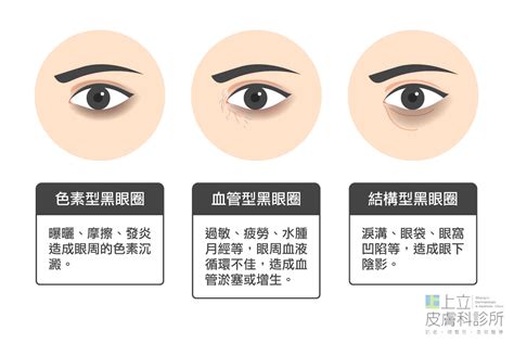 眼睛周圍黑|你的「黑眼圈」是哪一型？血管型、色素型、結構型.